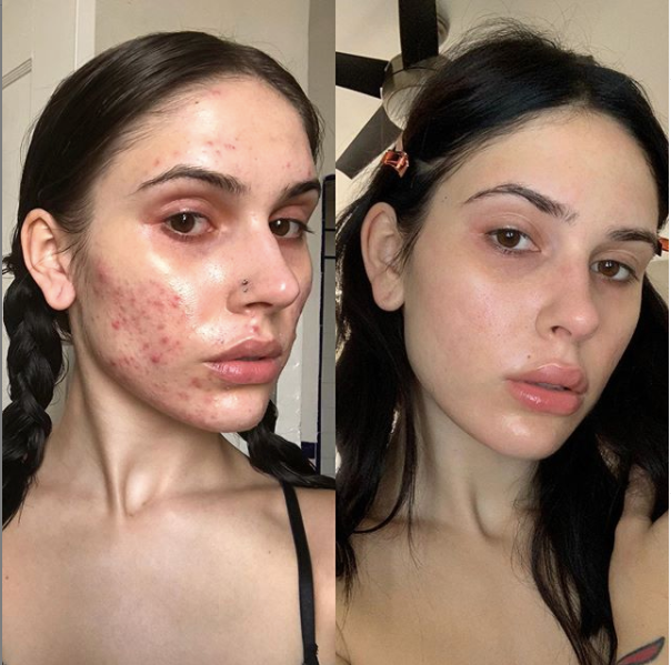 Máscara antiacne Piny + Booster
